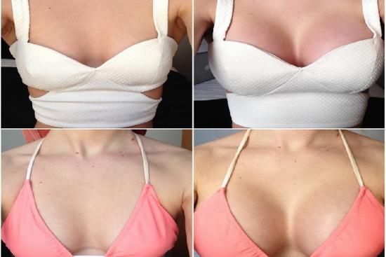  Photos: Before / After 0 in Turkey breast augmentation,augmentation,price,breast implant surgery,surgery,breast enlargement,enlargement,boob job,cost,breast implants types,types,doctor,turkey,clinic