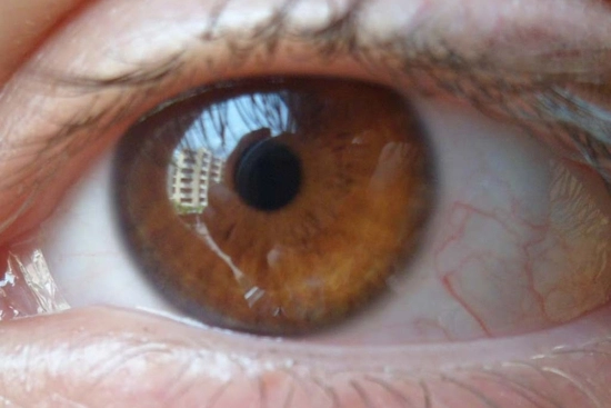 Риски и побочные эффекты факичных имплантатов ICL 2026