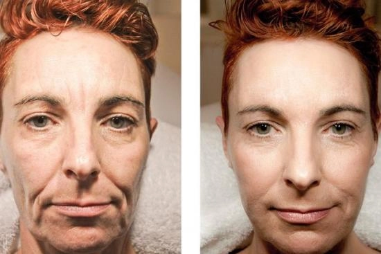 of our patients 0 surgery,cost,collagen injections,benefits,skin,injectable collagen side effects,injectable,side effects,breast enlargement,nose lift, Turkey, Istanbul