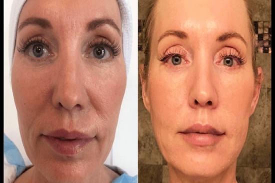  Photos: Before / After 0 in Turkey Vampire facial,platelet rich plasma prp facial treatment in istanbul,facial, treatment, istanbul,platelet,rich,plasma,istanbul,Side effects,price