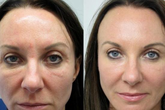  Before / After Photos 0 Vampire facial,platelet rich plasma prp facial treatment in istanbul,facial, treatment, istanbul,platelet,rich,plasma,istanbul,Side effects,price