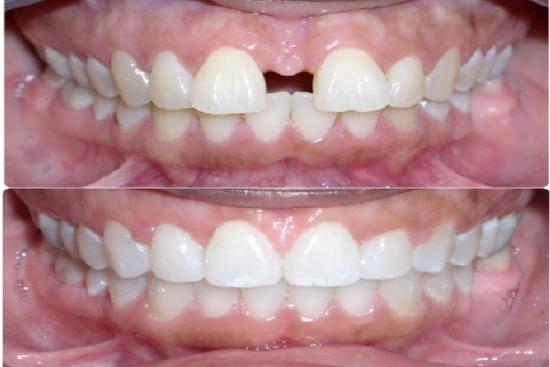  Photos: Before / After 0 in Turkey Invisalign braces, invisible aligners, cheap, turkey, teeth straightening, dentist, price