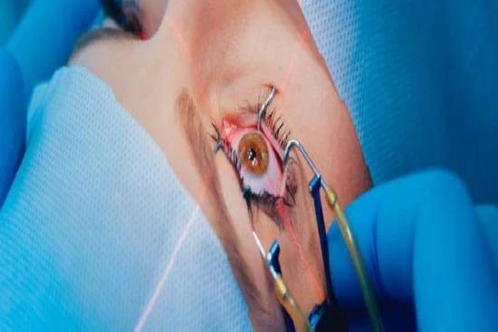 Indications for Optical Iridectomy 2024