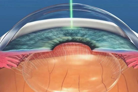 Роль иридопластики в лечении глаукомы с угловым закрытием глаза 2024