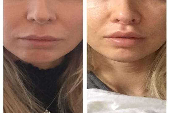  Photos: Before / After 0 in Turkey lips aesthetic surgery, aesthetic surgery,fillers, lip lift, lift, turkey, istanbul, price