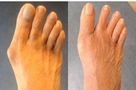 Photos Avant / Après 4 Hallux valgus, opération, Turquie, convalescence, prix, taux de réussite, chirurgie