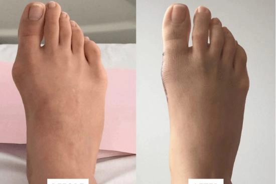 Photos Avant / Après 0 Hallux valgus, opération, Turquie, convalescence, prix, taux de réussite, chirurgie
