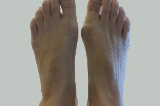 Photos Avant / Après 2 Hallux valgus, opération, Turquie, convalescence, prix, taux de réussite, chirurgie