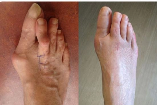 Photos Avant / Après 3 Hallux valgus, opération, Turquie, convalescence, prix, taux de réussite, chirurgie