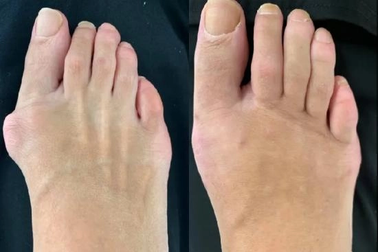 Photos Avant / Après 5 Hallux valgus, opération, Turquie, convalescence, prix, taux de réussite, chirurgie