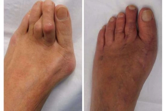 Photos Avant / Après 1 Hallux valgus, opération, Turquie, convalescence, prix, taux de réussite, chirurgie