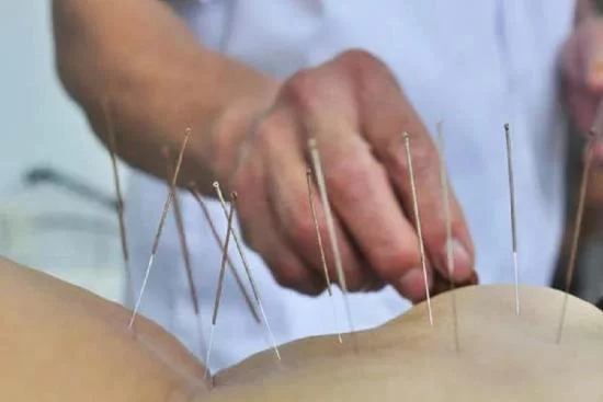 L’acupuncture 