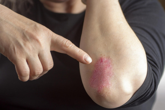 Psoriasis treatment