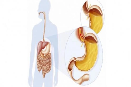 Reflux Gastro-Oesophagien 