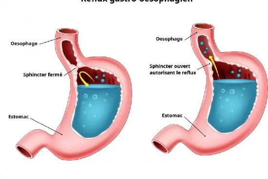 Reflux Gastro-Oesophagien 