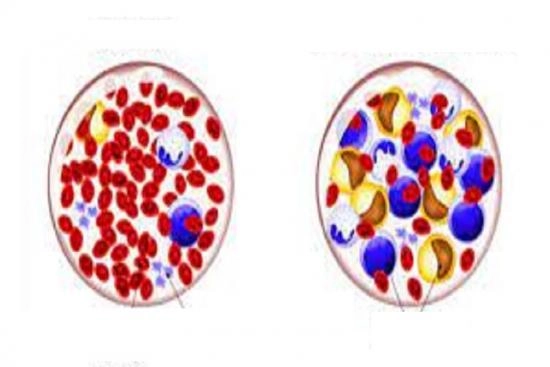 Leukemia treatment Turkey 