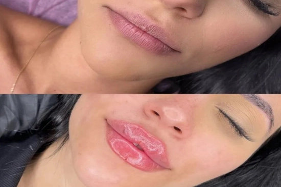 russian lips before/after