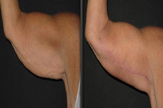 of our patients 2 arm lift,clinic,hospital,prices,recovery,brachioplasty,non surgical arm lift,non surgical,arm liposuction,liposuction,turkey,istanbul,cost,doctor