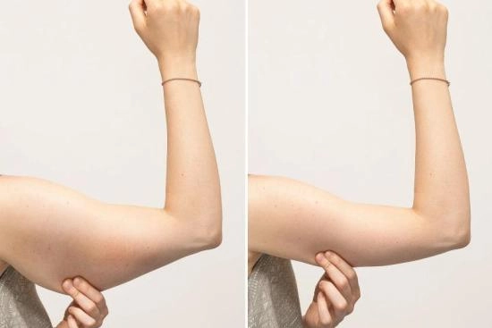 of our patients 0 arm lift,clinic,hospital,prices,recovery,brachioplasty,non surgical arm lift,non surgical,arm liposuction,liposuction,turkey,istanbul,cost,doctor