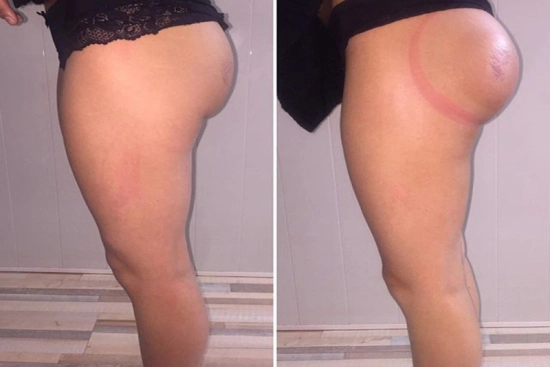 Photos Avant / Après 2 BBL en Turquie, lifting brésilien des fesses, prix, avis, chirurgie bbl, lipofilling, Turquie
