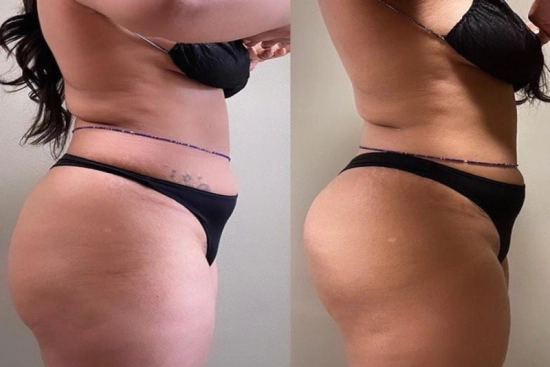 Photos Avant / Après 1 BBL en Turquie, lifting brésilien des fesses, prix, avis, chirurgie bbl, lipofilling, Turquie
