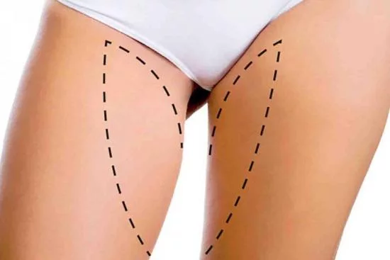 Costs of thigh lift in Istanbul, Turkey