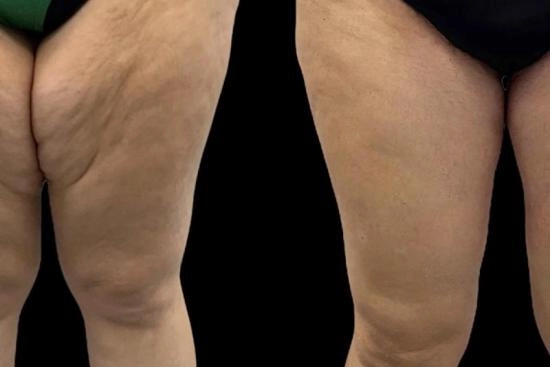 of our patients 3 thighplasty, thigh lift, cruroplasty, turkey, istanbul, cost