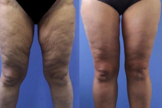 of our patients 1 thighplasty, thigh lift, cruroplasty, turkey, istanbul, cost