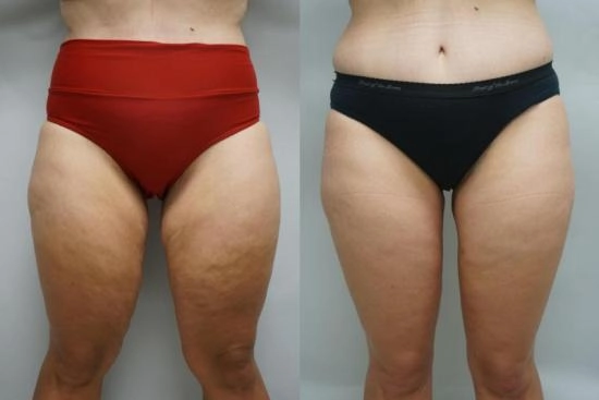 of our patients 2 thighplasty, thigh lift, cruroplasty, turkey, istanbul, cost