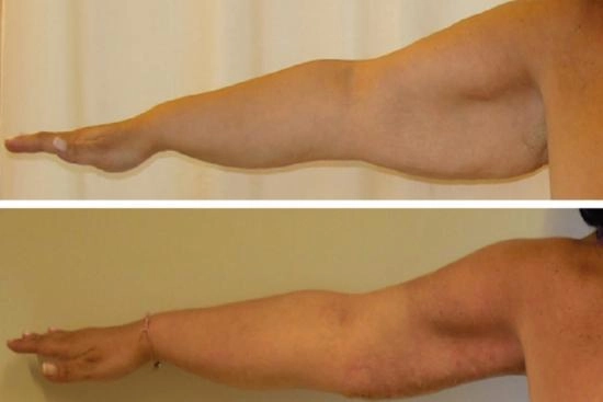 of our patients 1 arm lift,clinic,hospital,prices,recovery,brachioplasty,non surgical arm lift,non surgical,arm liposuction,liposuction,turkey,istanbul,cost,doctor