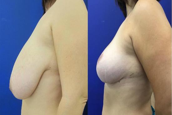  Photos: Before / After 0 in Turkey recovery, cost, prices, turkey, mastopexy, breast lift, doctor, non surgical