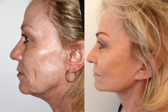  Photos: Before / After 0 in Turkey price,one stitch facelift in turkey,one stitch, facelift,endoscopic,smas facelift technique,rhytidectomy,smas,technique,turkey,doctor,clinic,hospital