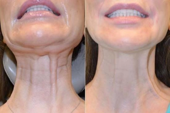 of our patients 3 endoscopic, mid facelift, cost, turkey, doctor, clinic