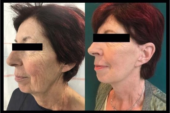 of our patients 2 endoscopic, mid facelift, cost, turkey, doctor, clinic