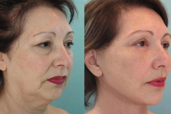 Photos Avant / Après 0 lifting médian, istanbul, Turquie, Medio-facial, prix