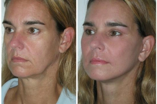 of our patients 1 endoscopic, mid facelift, cost, turkey, doctor, clinic
