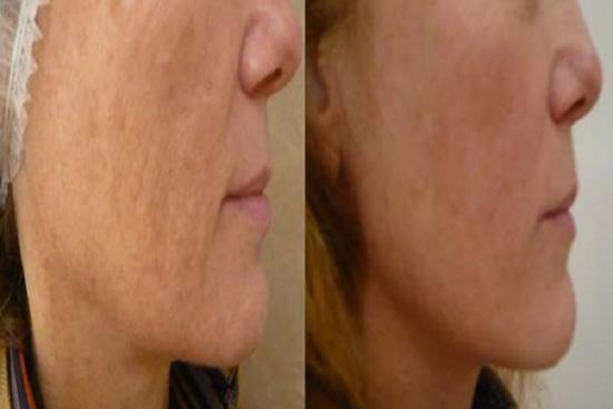  Photos: Before / After 0 in Turkey istanbul,thread face lift cost in turkey,face,cost,procedure,turkey,doctor,clinic,hospital,cosmetic surgeon,pdo thread lift,pdo