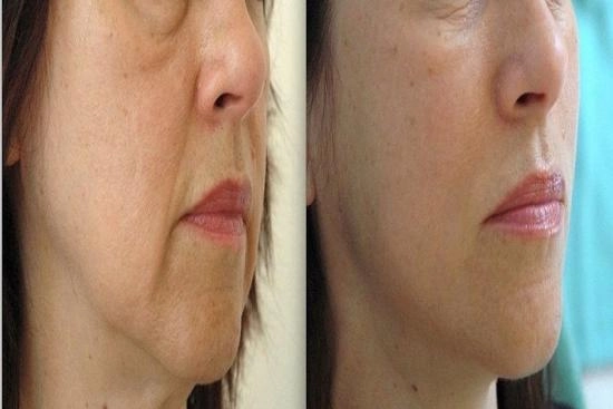 of our patients 1 Facelift, permanent tensor threads, Price, Turkey, results