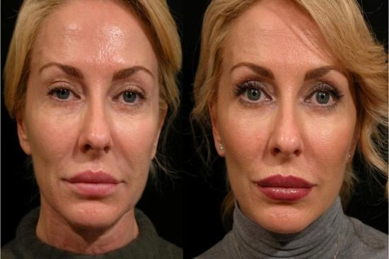 de nuestros pacientes 0 lifting facial, lifting cérvico-facial, Turquía, precio, resultados, efectos secundarios
