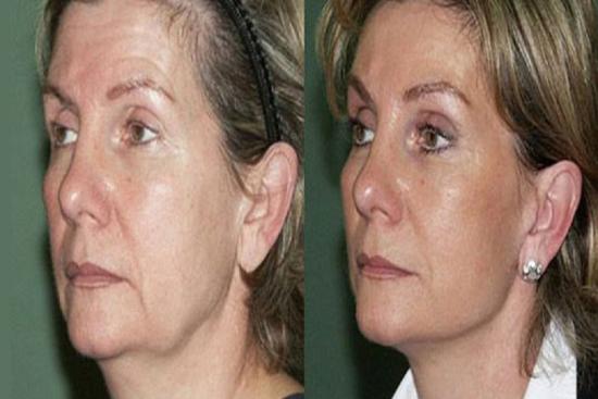  Photos: Before / After 0 in Turkey cost,invasive,best,hifu,price,cosmetic,caci,facial,jowls, Turkey, Istanbul, non-surgical facelift