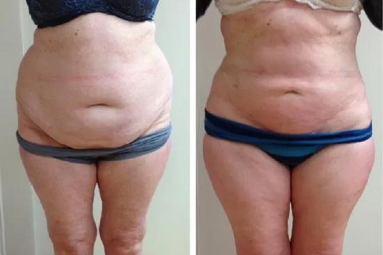  Photos: Before / After 0 in Turkey cost,Liposuction, turkey, antalya, izmir, istanbul, clinics, doctors, reviews, VASER,price,best liposuction,cheap liposuction