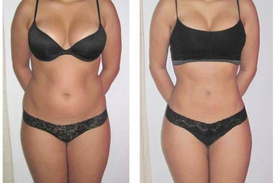 360° Liposuction in Turkey at 2600€ | Clinics & Reviews