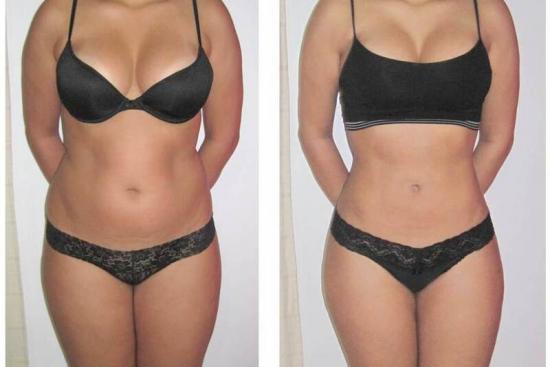 11 Best Clinics for Liposuction in Beirut [2023 Prices]