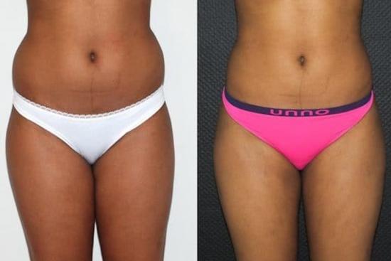  Photos: Before / After 0 in Turkey 360° liposuction, prices, Antalya, Turkey, clinics, reviews, double-sieded lipo
