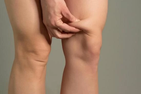 Liposuccion des genoux 