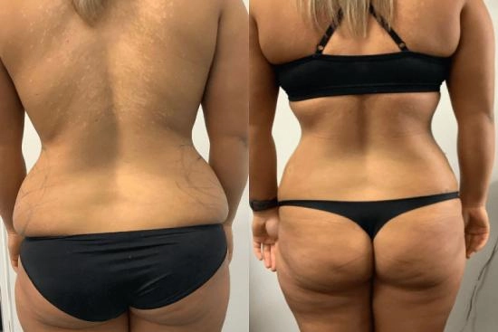 of our patients 0 hip liposuction, turkey, love handles, saddlebags, results, risks, complications