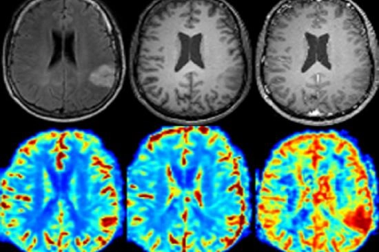 Brain tumor surgery in Turkey