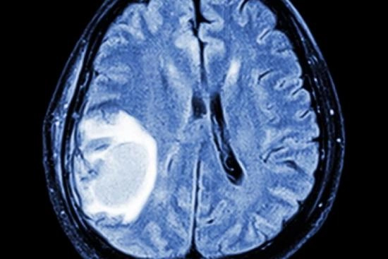 Meningioma treatment