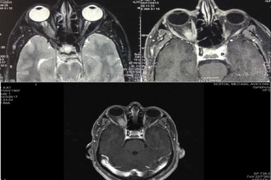 Meningioma surgery cost