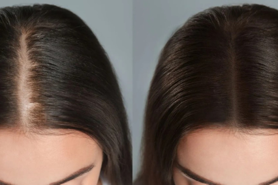 Mésogreffe capillaire (Rigenera) en Turquie : procédure, résultats et prix